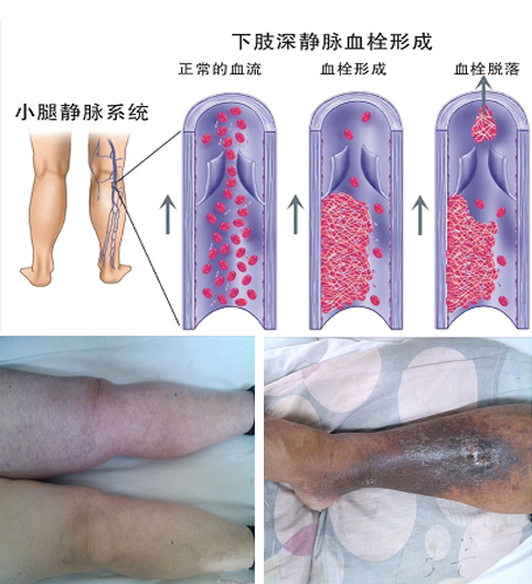 血栓.jpg 血栓.jpg