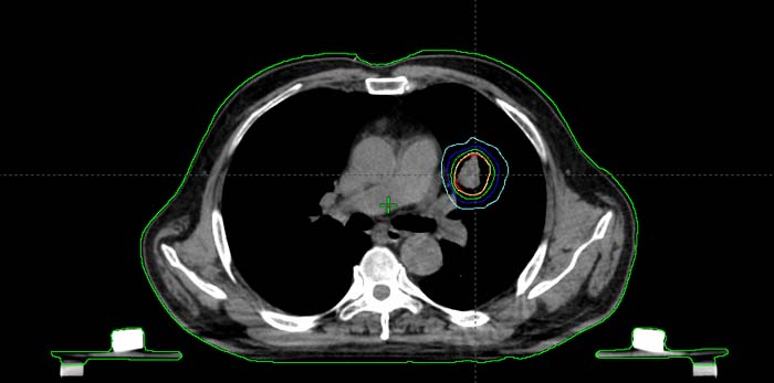 肺癌大分割放疗计划剂量线.jpg 肺癌大分割放疗计划剂量线.jpg